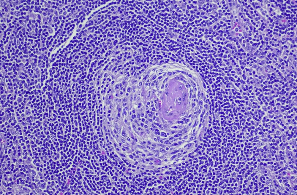 Top 5 Breakthroughs in Castleman Disease: New Subtype Found 2 image 357